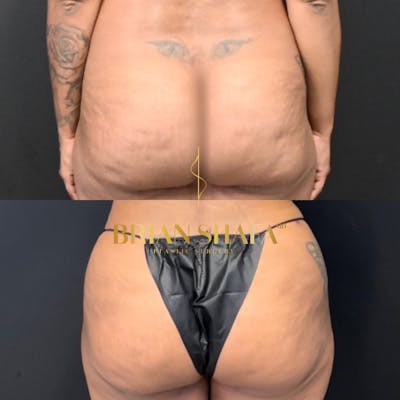 Avéli™ Cellulite Reduction Before & After Photos - Patient 169965 - Image 1