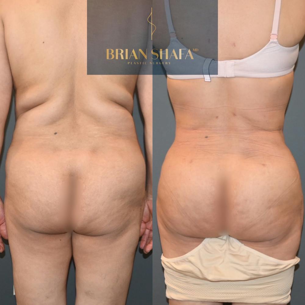 Brazilian Butt Lift Before & After Photos - Patient 119703 - Image 1