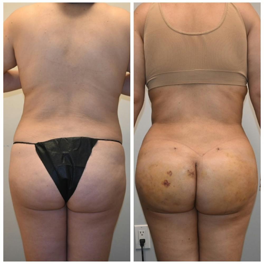 Brazilian Butt Lift Before & After Gallery - Patient 363174 - Image 1