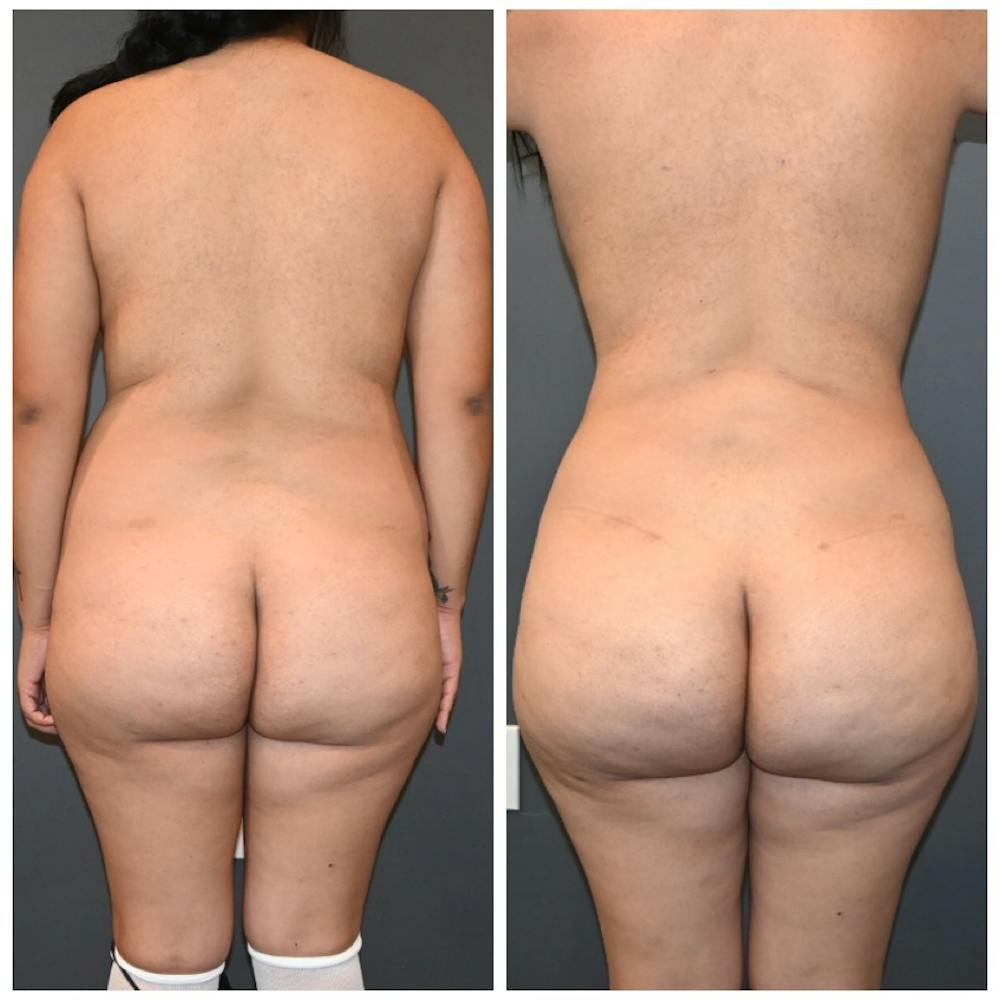 Brazilian Butt Lift Before & After Photos - Patient 222094 - Image 1