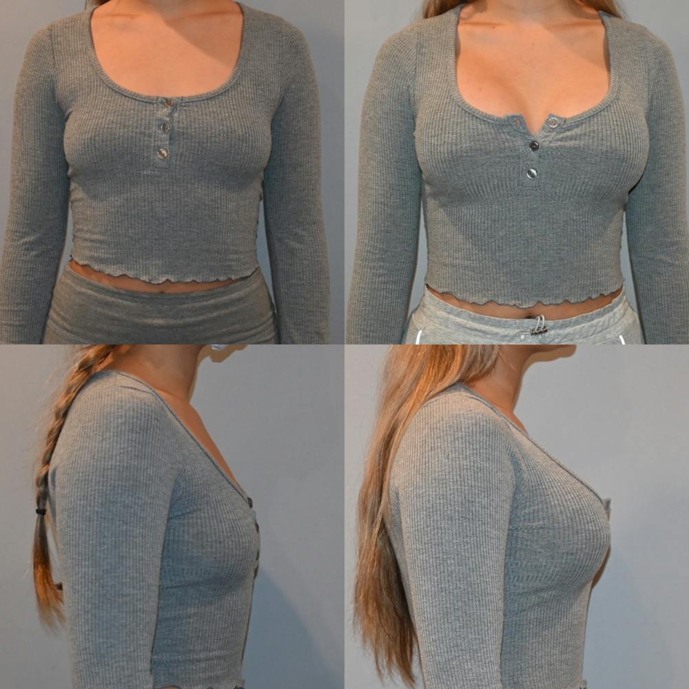 Breast Augmentation  Before & After Photos - Patient 193573 - Image 1