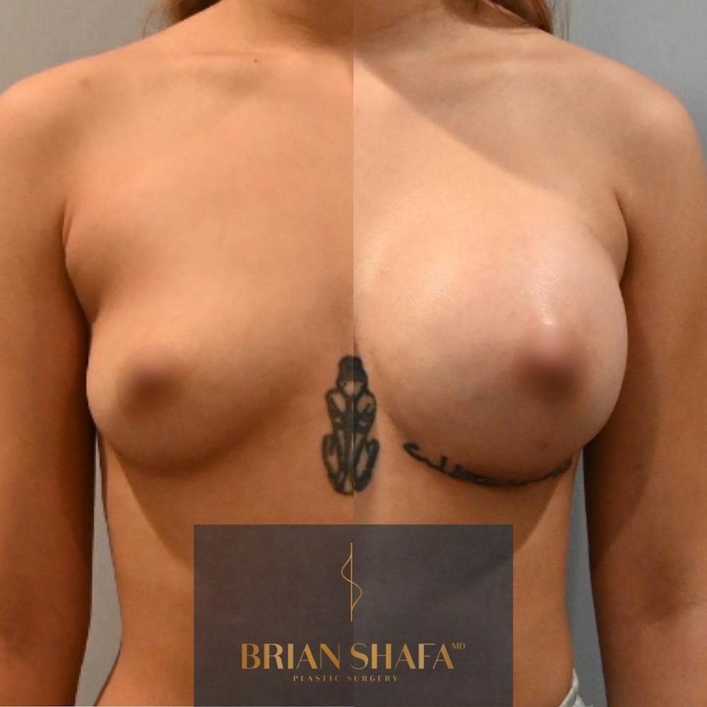 Breast Augmentation  Before & After Gallery - Patient 487752 - Image 1