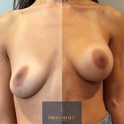 Breast Augmentation  Before & After Gallery - Patient 338982 - Image 1