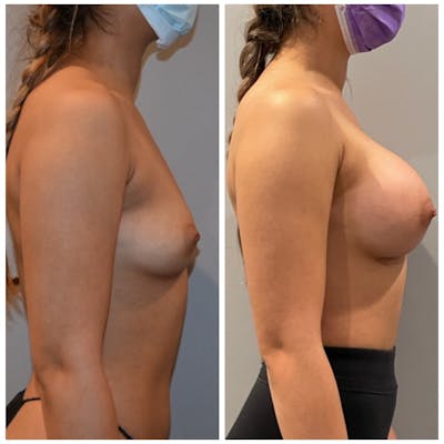Breast Augmentation  Before & After Gallery - Patient 487752 - Image 2