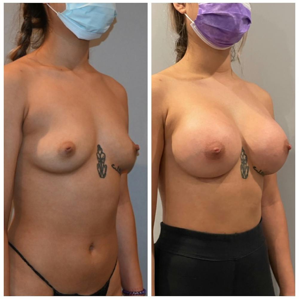 Breast Augmentation  Before & After Photos - Patient 487752 - Image 3