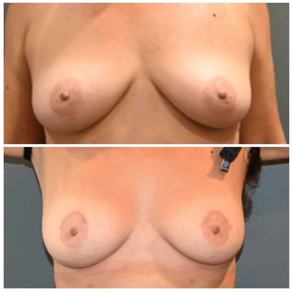 Breast Lift Before & After Photos - Patient 113314 - Image 1