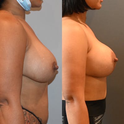 Breast Lift Before & After Photos - Patient 893494 - Image 1