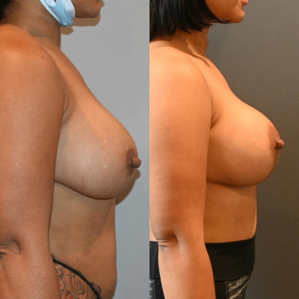 Breast Lift Before & After Gallery - Patient 893494 - Image 1