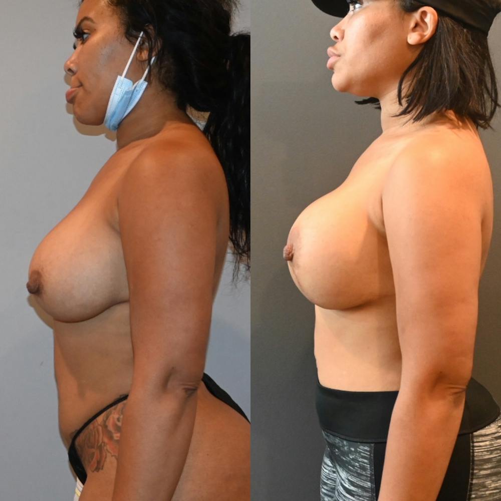 Breast Lift Before & After Gallery - Patient 893494 - Image 2