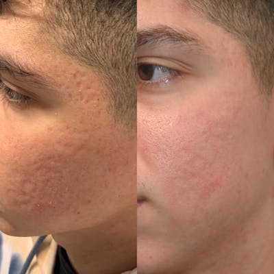 CO2 Laser Resurfacing Before & After Photos - Patient 265110 - Image 1