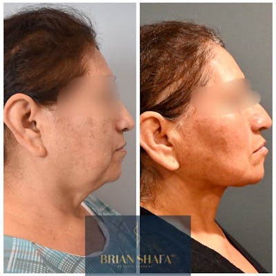 Facelift/Necklift Before & After Gallery - Patient 175025 - Image 1