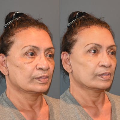 Facelift/Necklift Before & After Photos - Patient 146778899 - Image 1