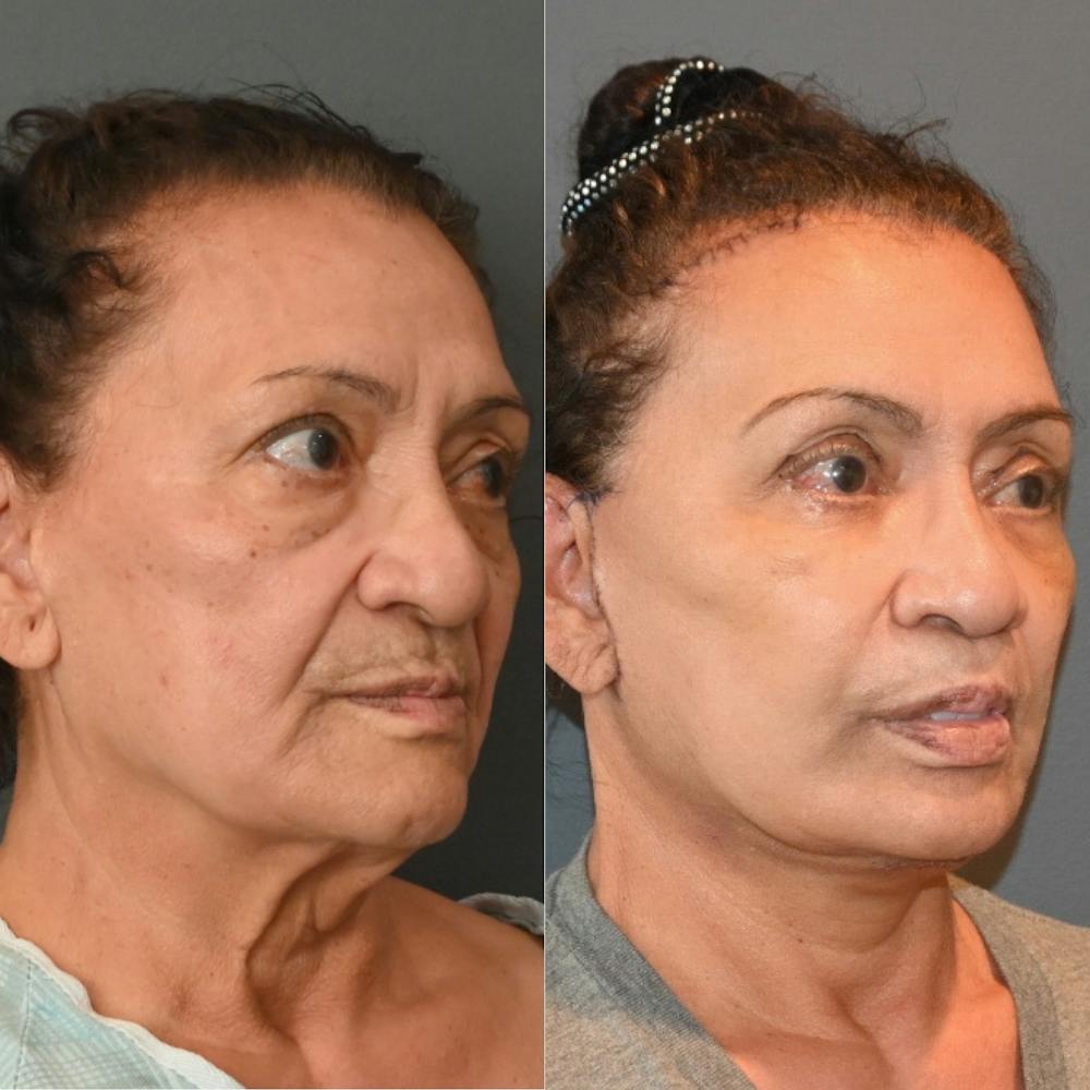 Facelift/Necklift Before & After Gallery - Patient 146778899 - Image 2