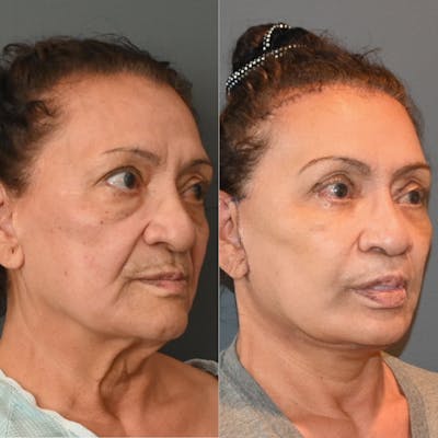 Facelift/Necklift Before & After Gallery - Patient 146778899 - Image 2