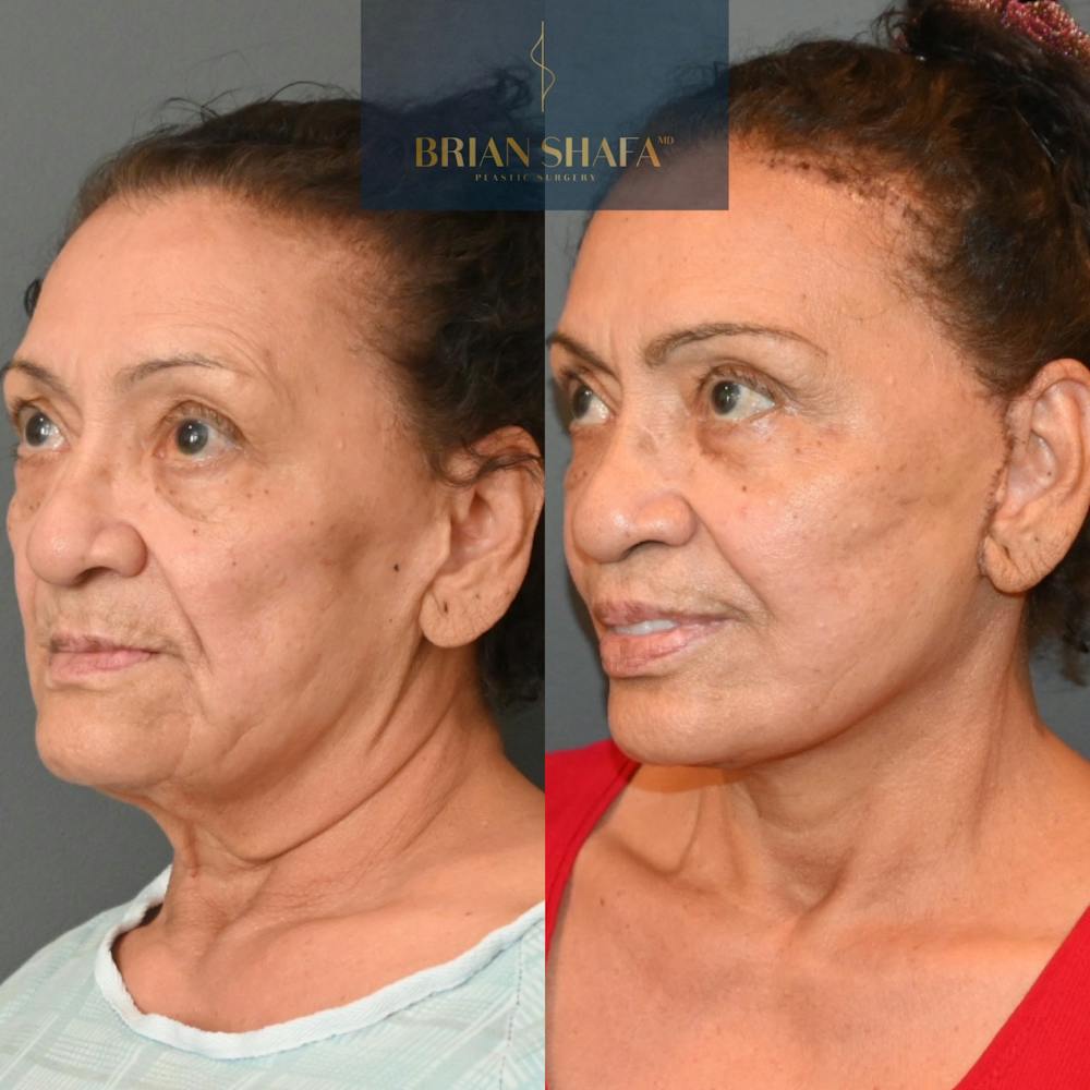 Facelift/Necklift Before & After Gallery - Patient 146778899 - Image 3