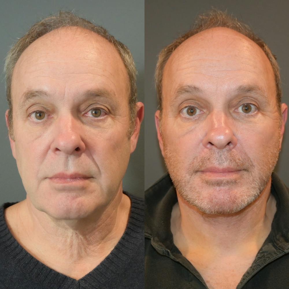 Facelift/Necklift Before & After Gallery - Patient 146286927 - Image 1