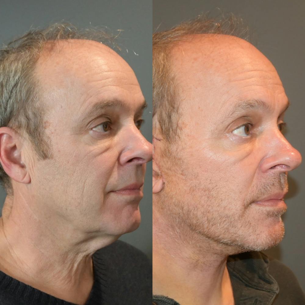 Facelift/Necklift Before & After Gallery - Patient 146286927 - Image 2