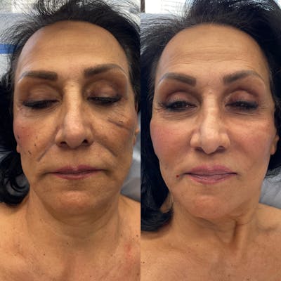 Facial Fat Grafting Before & After Photos - Patient 128003 - Image 1