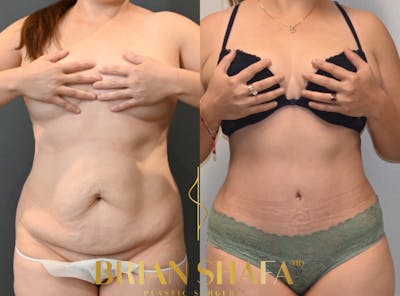 High-Def Liposuction  Before & After Photos - Patient 146778863 - Image 1