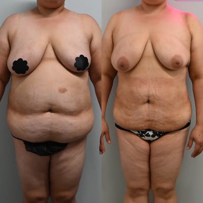 High Volume Lipo Before & After Gallery - Patient 338154 - Image 1