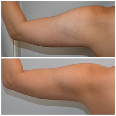 Arm Liposuction Before & After Photos - Patient 420194 - Image 1
