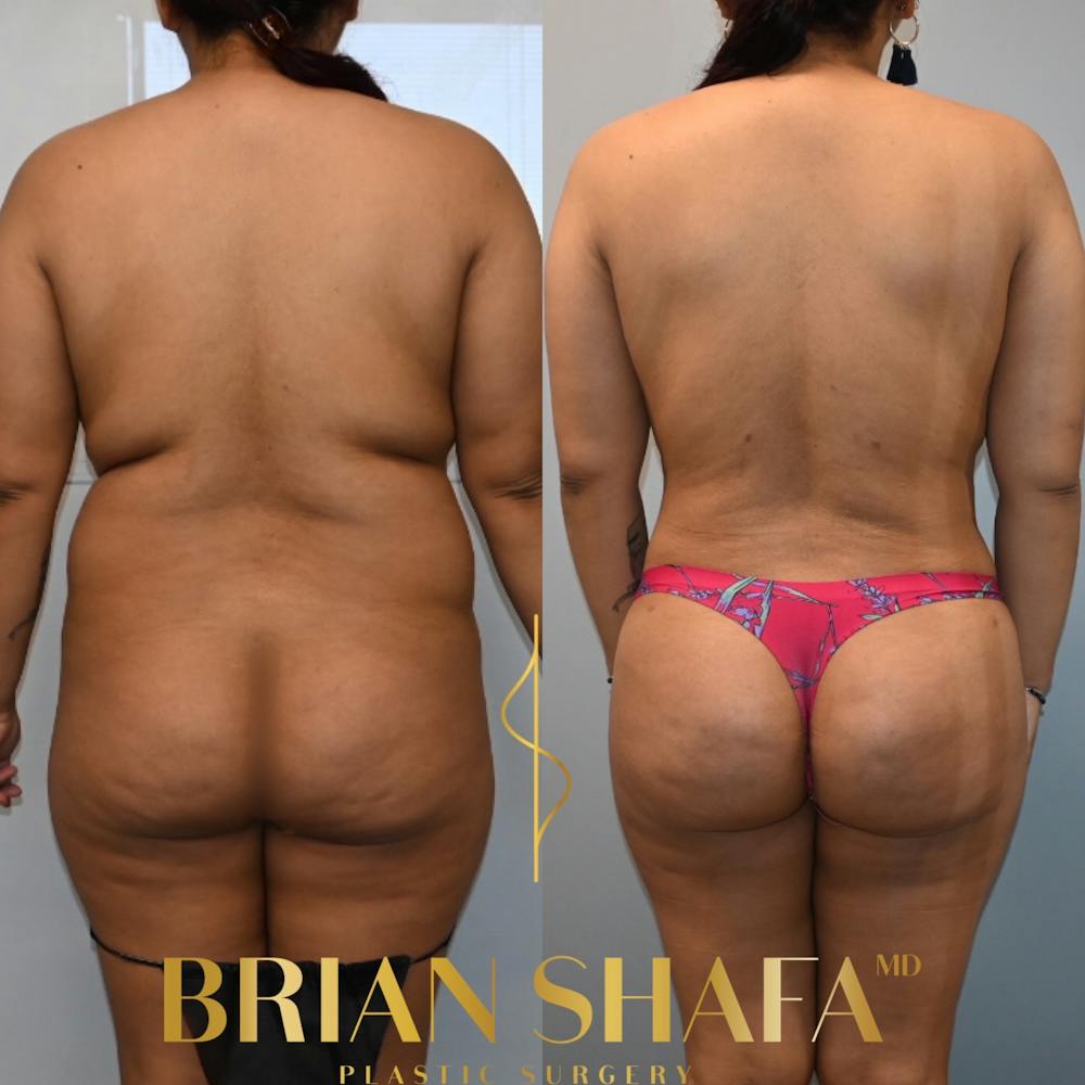 Lipo 360 Before & After Gallery - Patient 409574 - Image 2