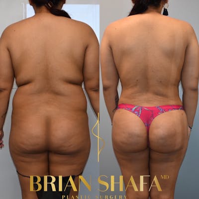 Lipo 360 Before & After Photos - Patient 409574 - Image 2