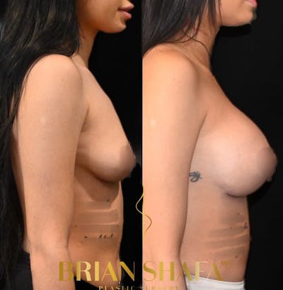 Breast Augmentation  Before & After Photos - Patient 839548 - Image 2