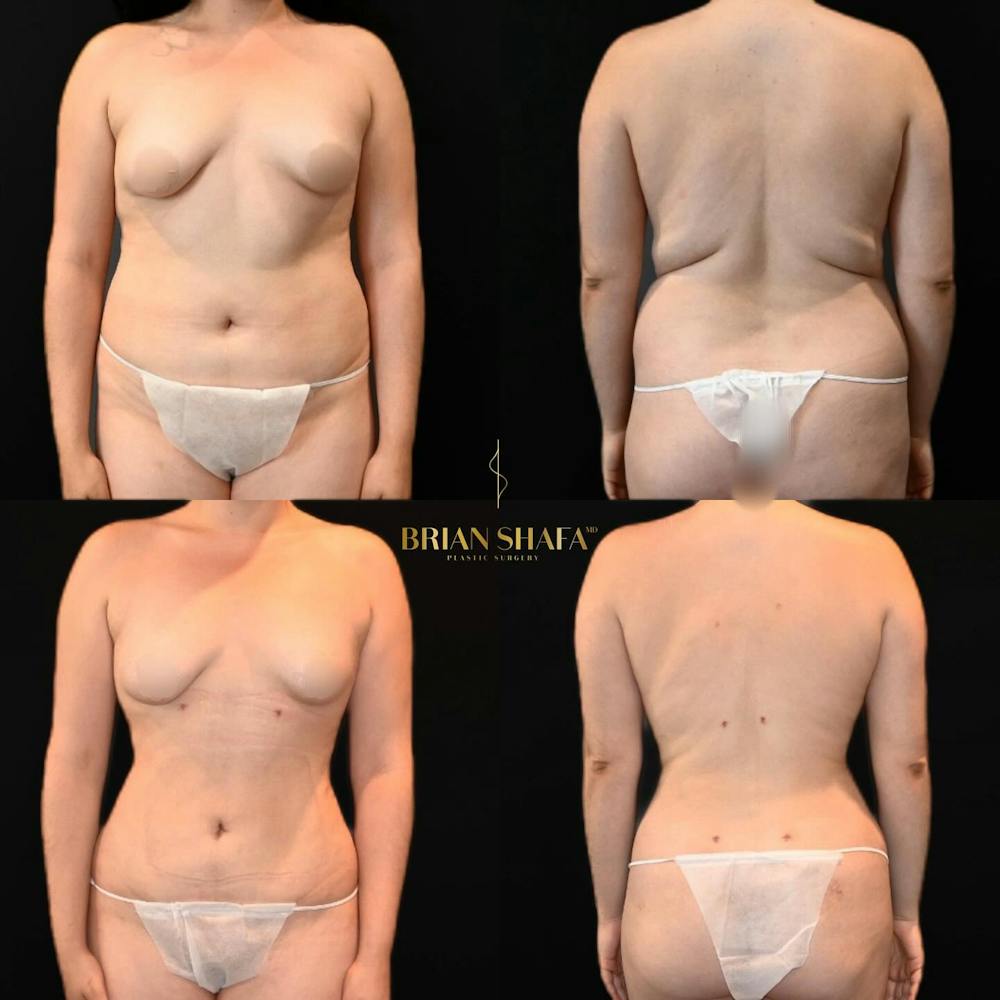 Lux Lipo Before & After Photos - Patient 106639 - Image 1