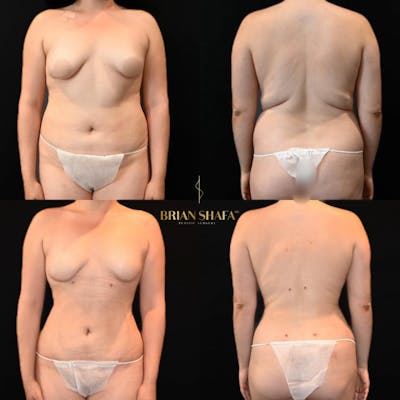 Lux Lipo Before & After Gallery - Patient 106639 - Image 1