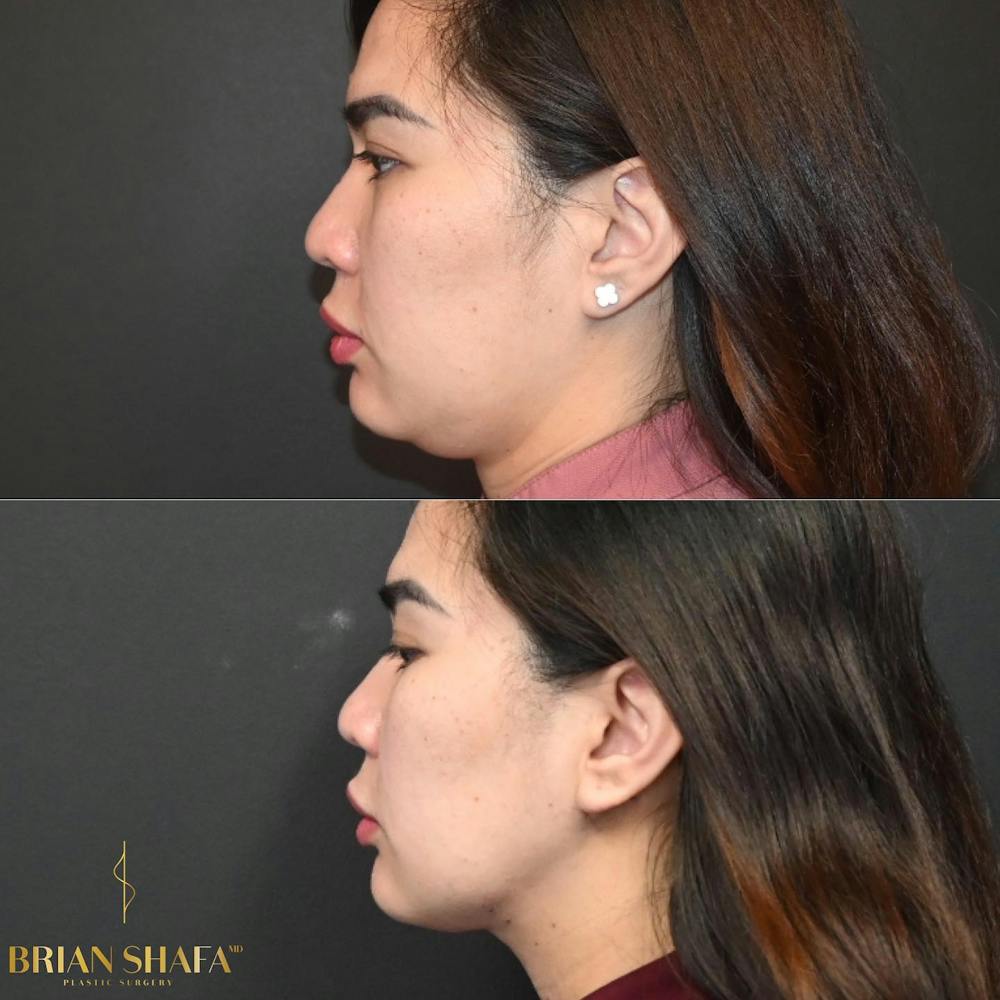 Lux Lipo Before & After Photos - Patient 110502 - Image 2