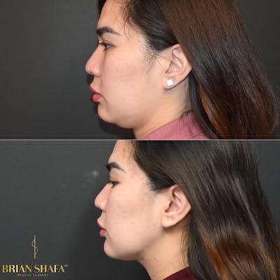 Lux Lipo Before & After Photos - Patient 110502 - Image 2