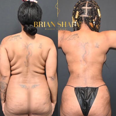 Lux Lipo Before & After Photos - Patient 511204 - Image 2