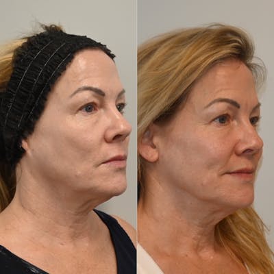 Morpheus8 Before & After Photos - Patient 408086 - Image 1