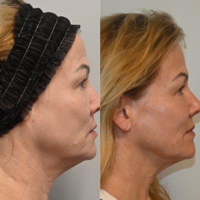 Morpheus8 Before & After Photos - Patient 408086 - Image 2