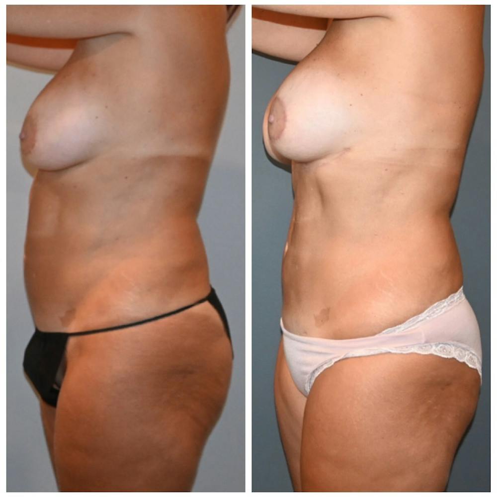 Reverse Tummy Tuck Before & After Gallery - Patient 218642 - Image 3