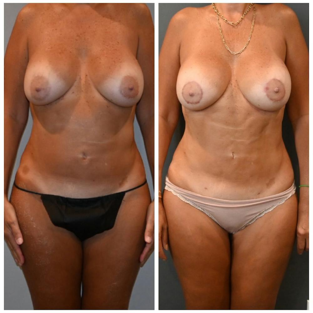 Reverse Tummy Tuck Before & After Gallery - Patient 218642 - Image 1