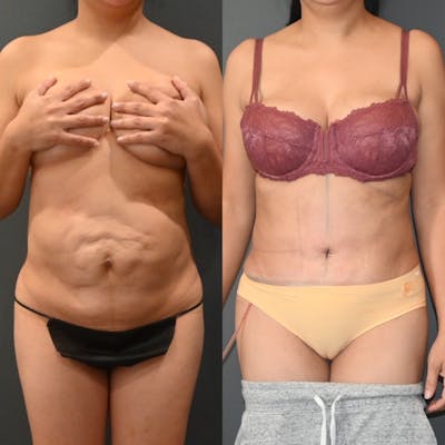 Tummy Tuck (Abdominoplasty) Before & After Gallery - Patient 420543 - Image 1