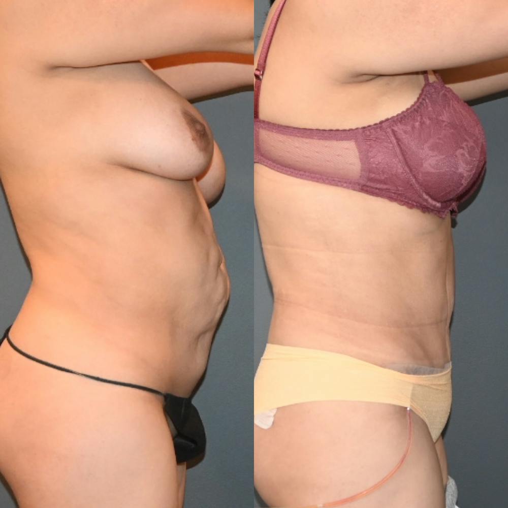 Tummy Tuck (Abdominoplasty) Before & After Gallery - Patient 420543 - Image 2