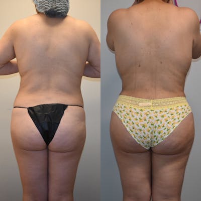 Brazilian Butt Lift Before & After Gallery - Patient 876598 - Image 1