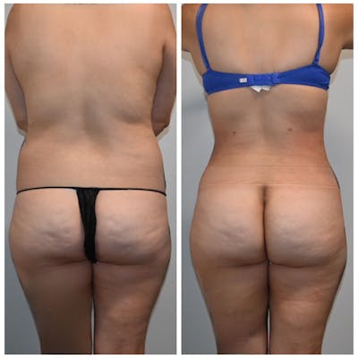 Brazilian Butt Lift Before & After Photos - Patient 381449 - Image 1