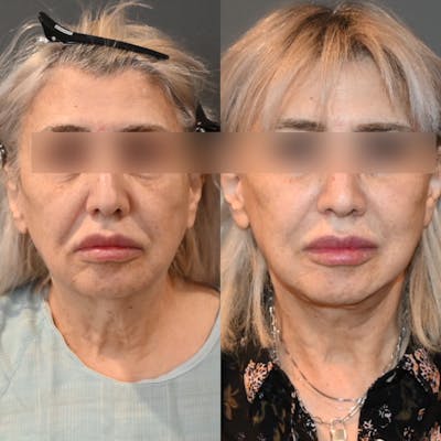 Facelift/Necklift Before & After Photos - Patient 325204 - Image 1