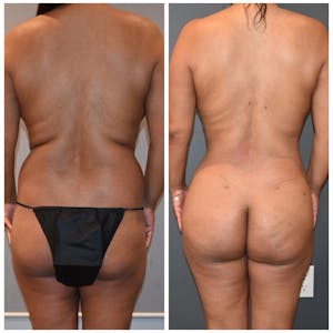 Lux Lipo in Santa Monica Before & After Photos