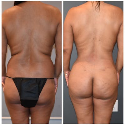 Lux Lipo Before & After Gallery - Patient 272297 - Image 1