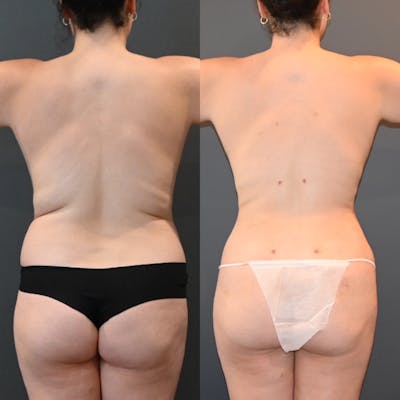 Lux Lipo Before & After Photos - Patient 170700 - Image 1