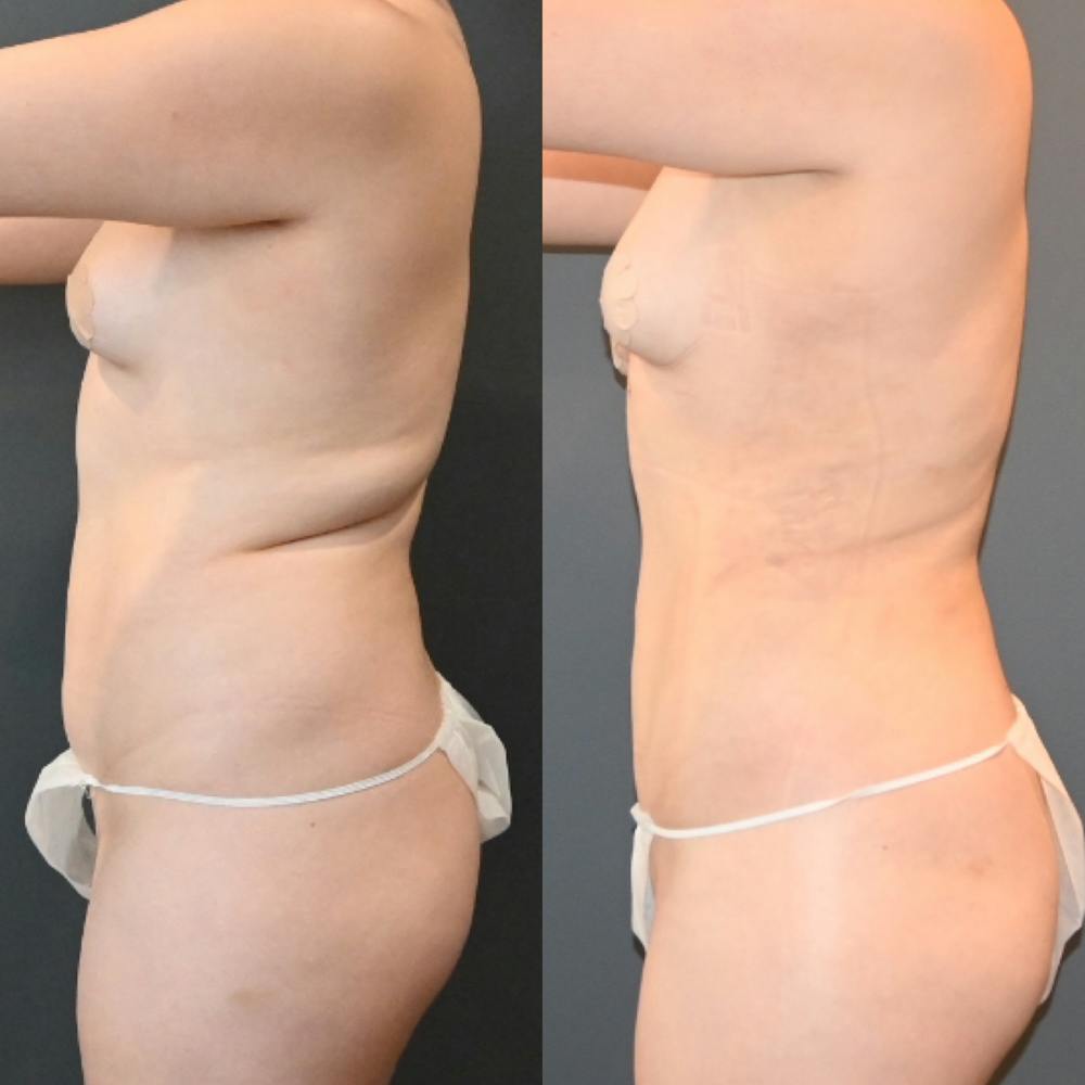 Lux Lipo Before & After Gallery - Patient 170700 - Image 2