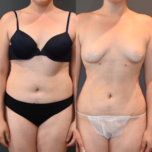 Lux Lipo in Beverly Hills