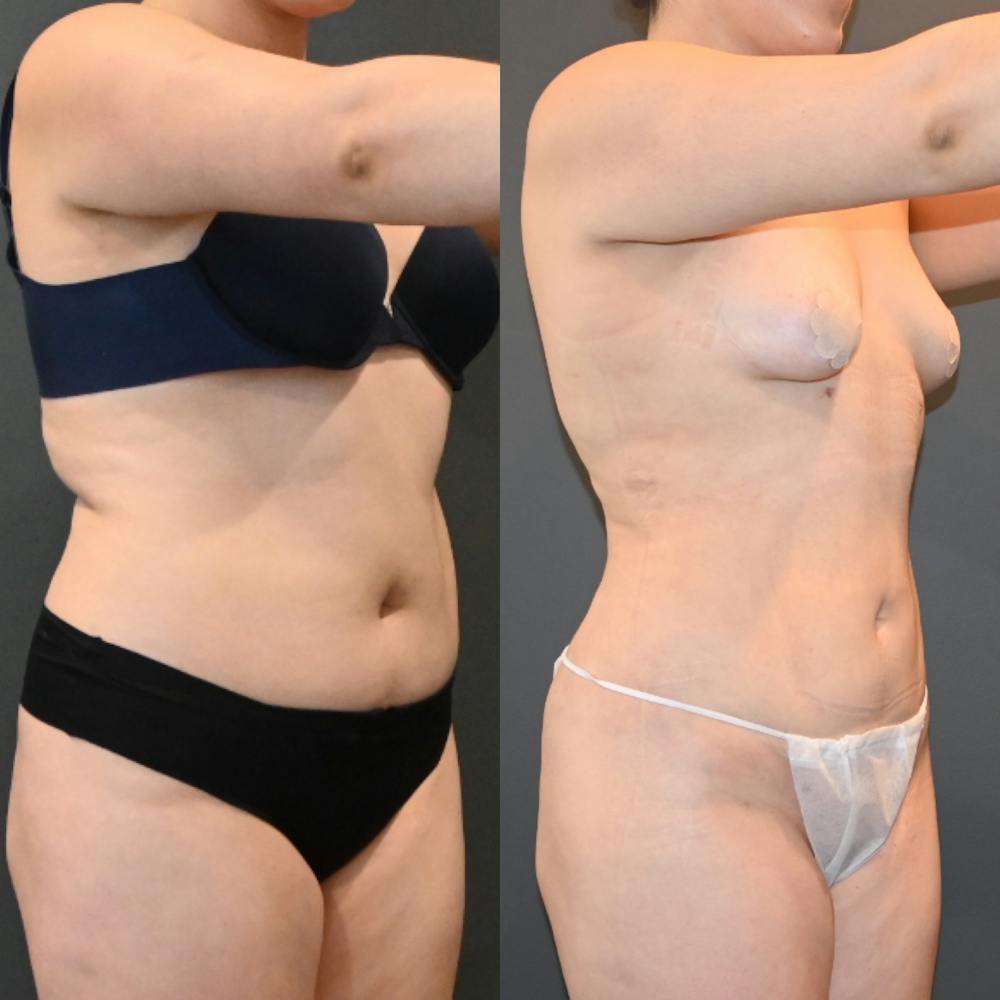 Lux Lipo Before & After Gallery - Patient 170700 - Image 4