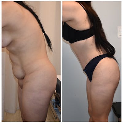 Tummy Tuck (Abdominoplasty) Before & After Photos - Patient 294896 - Image 1