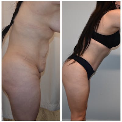 Tummy Tuck (Abdominoplasty) Before & After Photos - Patient 294896 - Image 2